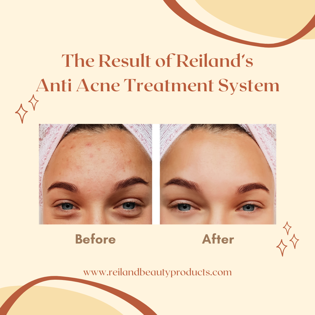 Visible Acne Reduction & Clearer Skin with Reiland Acne Treatment